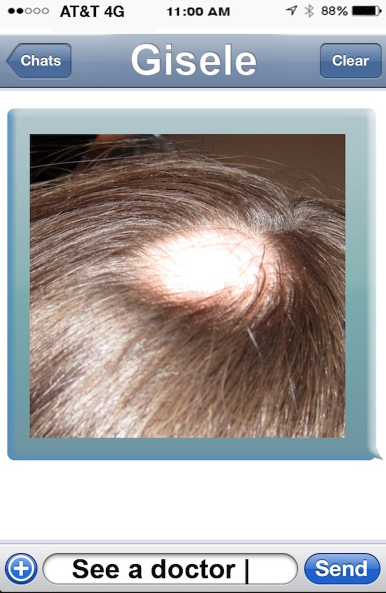 brady_bald_spot_2.jpg